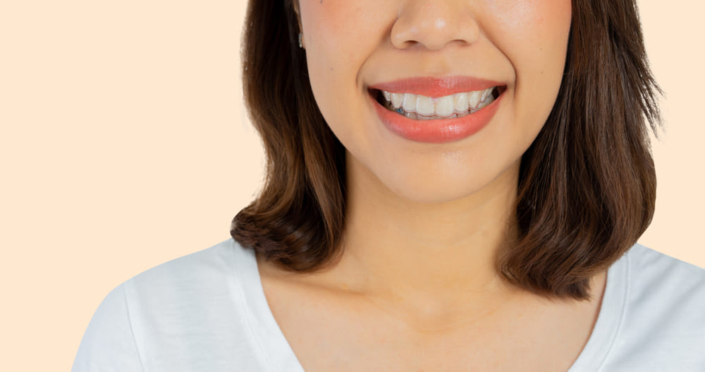 limpeza invisalign